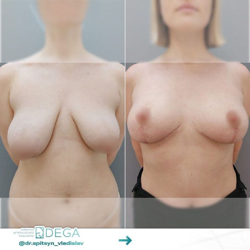 Результат коррекции тубулярной груди от пластического хирурга клиники DEGA Владислава Игоревича Спицына