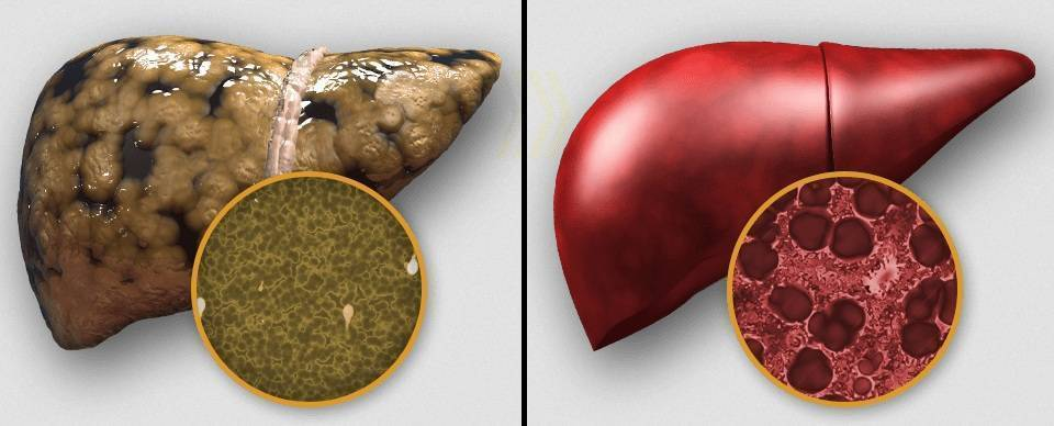 Печенье при циррозе печени. Жировой гепатоз макропрепарат. Токсический алкогольный цирроз печени.