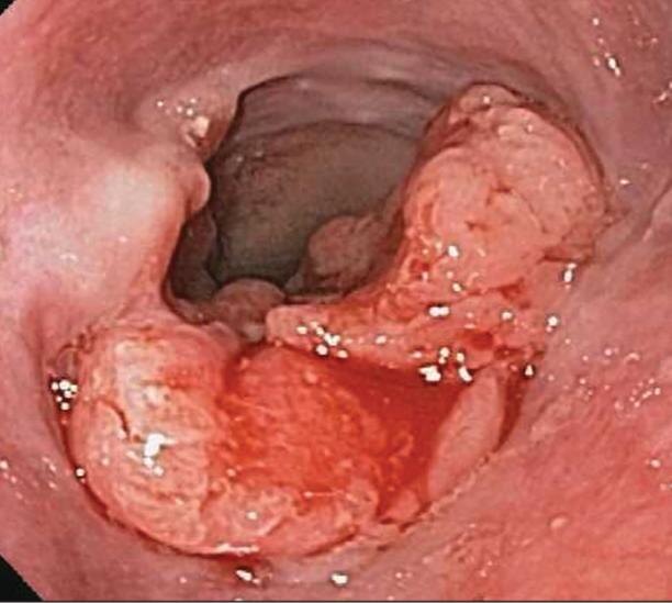 Один из разновидностей рака пищевода