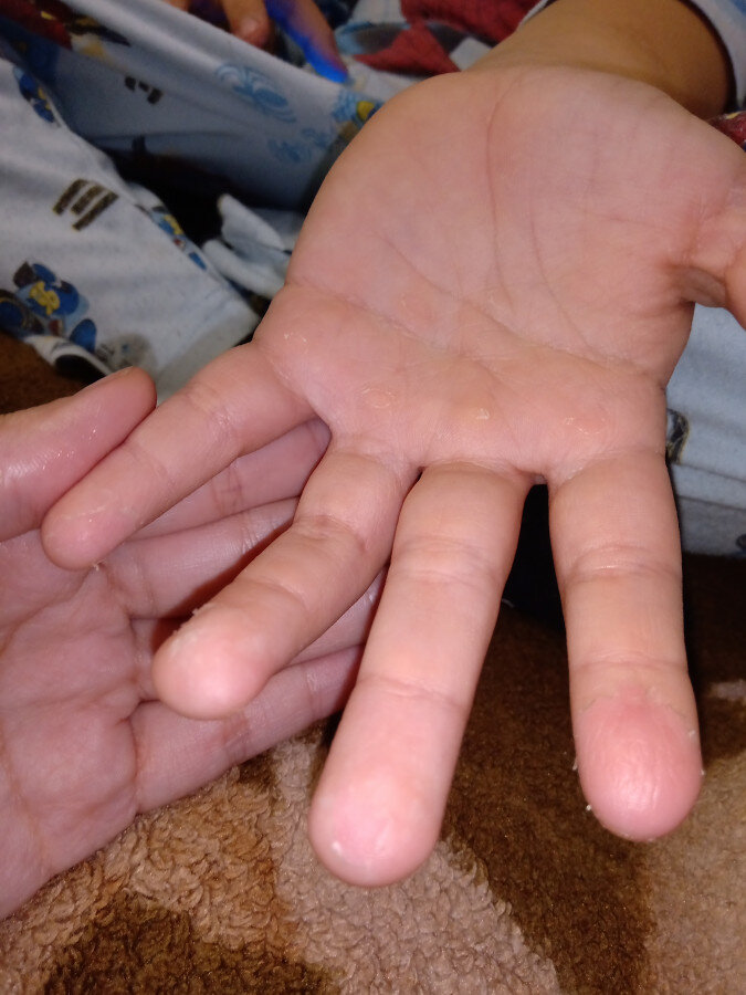 Области кожа с пальцев рук 