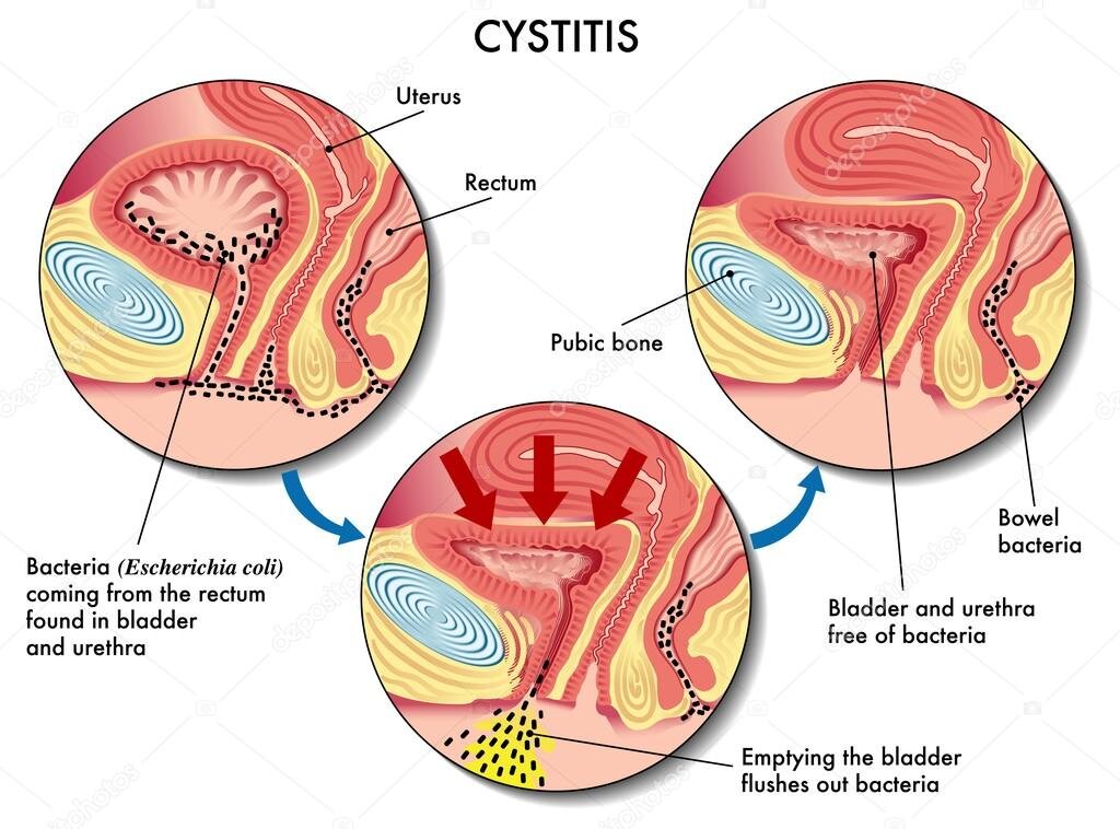 Процесс заражения и излечения