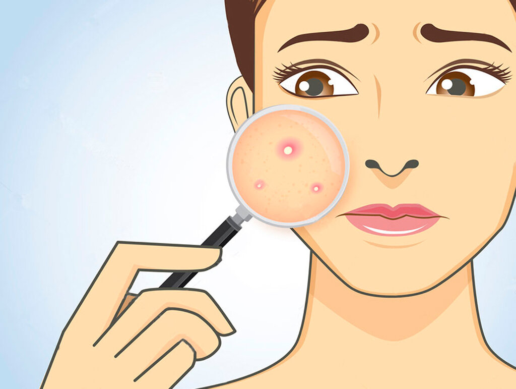 Избавиться от прыщей