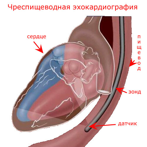 Чреспищеводная эхокардиография