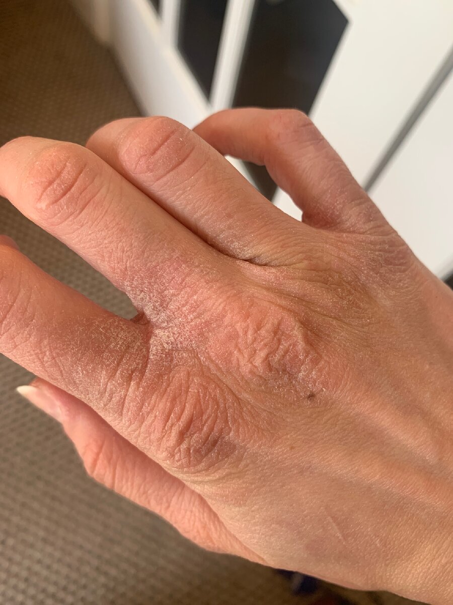 Последствия частого мытья рук и дезинфицирующих средств