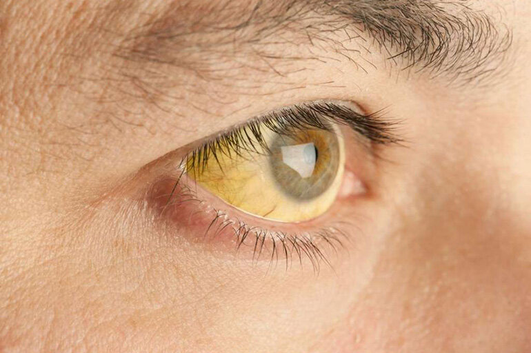 Глаза при остром или хроническом гепатите имеют желтушный окрас.