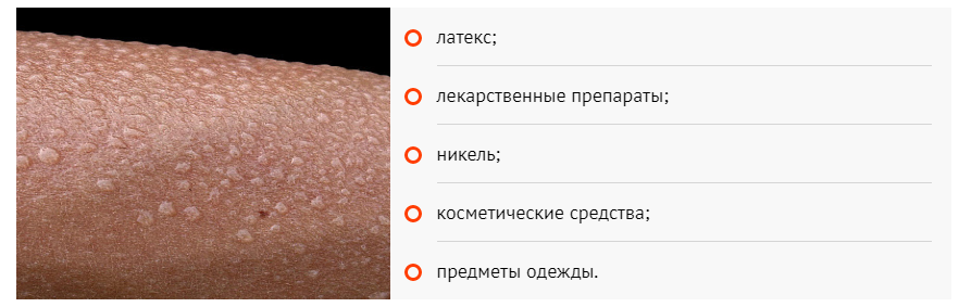 Контактный дерматит: что это, причины появления и методы лечения