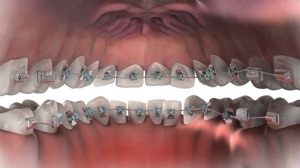 Лингвальные лигатурные брекеты. Лингвальные (невидимые) брекеты stb. Внутренние лингвальные брекеты. Лингвальные металлические брекеты. Изгиб зубов