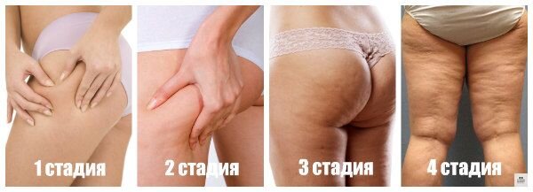 Стадии целлюлита