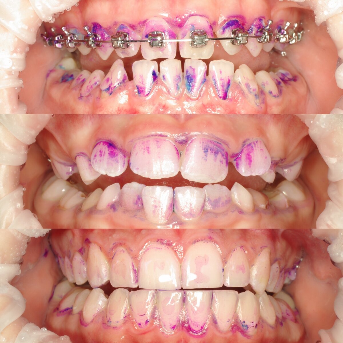 Индикация налёта у разных пациентов