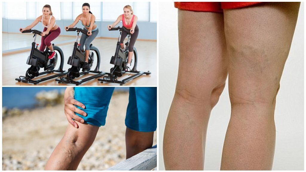 Спорт после операции. Варикоз вен нижних конечностей.