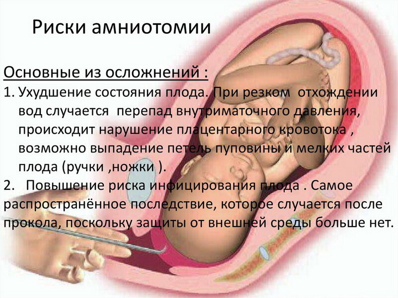 Предродовой разрыв плодных оболочек (ПРПО)