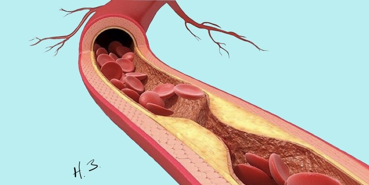 Могут ли рассосаться бляшки в сосудах