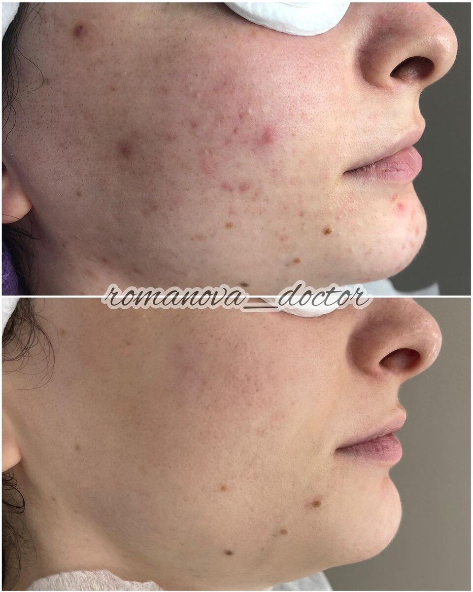 Результат до/после. Комплексное лечение акне. Результат за 3 месяца терапии. Работа Романовой Галины Владимировны.