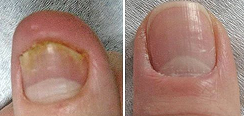 Грибок ногтя (онихомикоз)