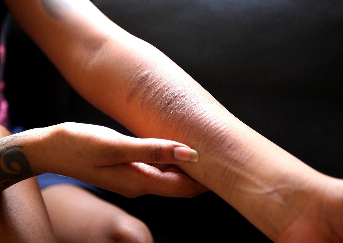 Нанесение себе физических повреждений