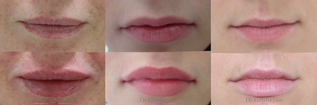 Фото До и После увеличения губ