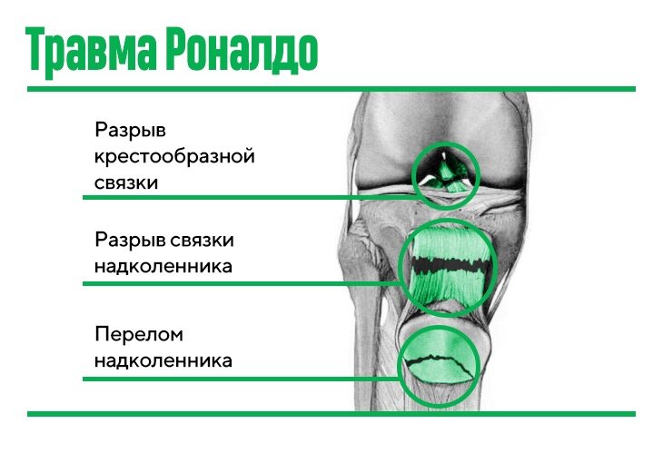 Разрывы и повреждения связок