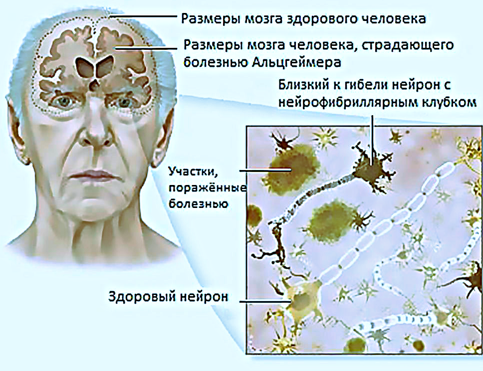 Признаки болезни альцгеймера у мужчин