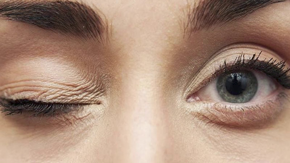 Хронические подергивания глаза  могут привести к блефароспазму