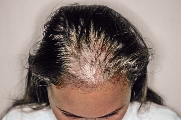 Выпадение волос