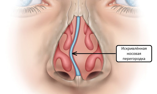 Как плохо, когда дышать нечем...