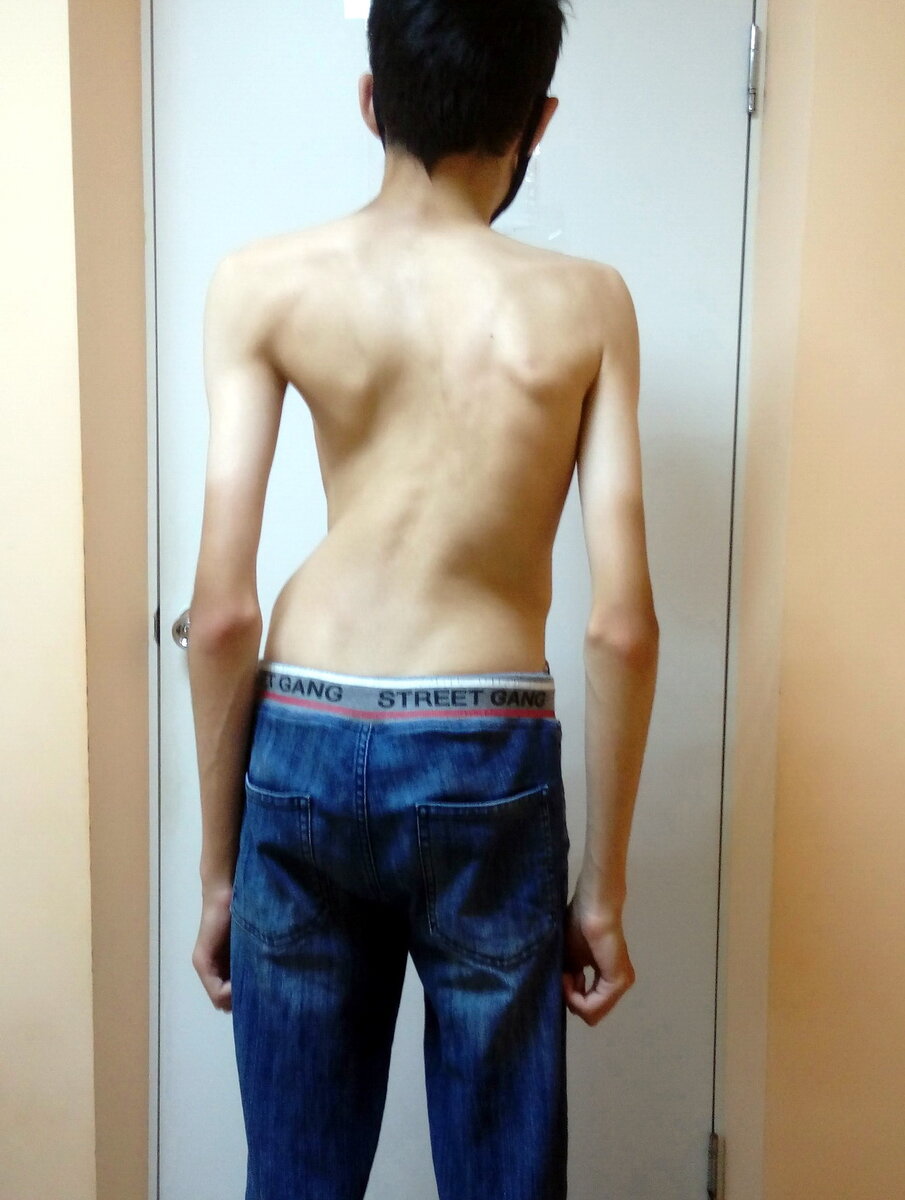 правосторонний кифосколиоз 3 ст.  