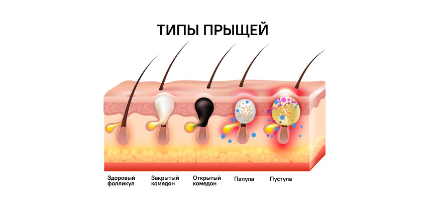 Причины прыщей на спине, груди или плечах