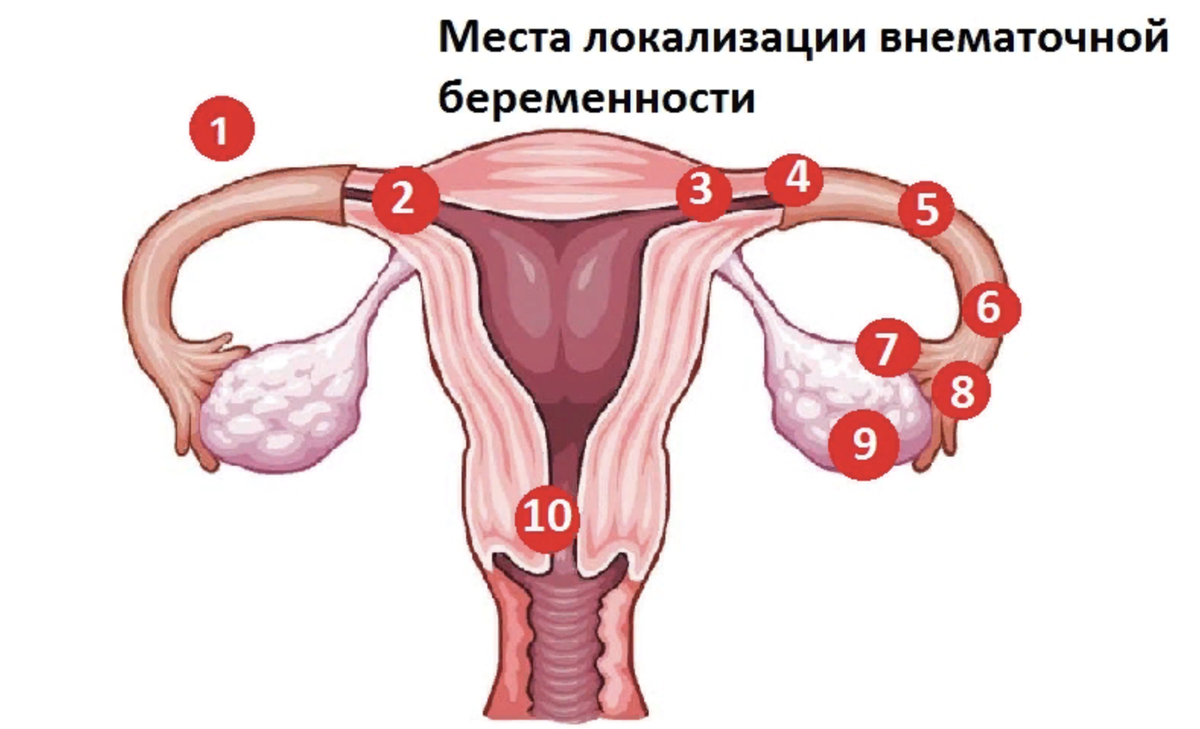 Невматочная беременность. Внематочная (эктопическая) беременность клиника. Разрыв маточной трубы внематочная беременность. Локализация внематочной беременности.