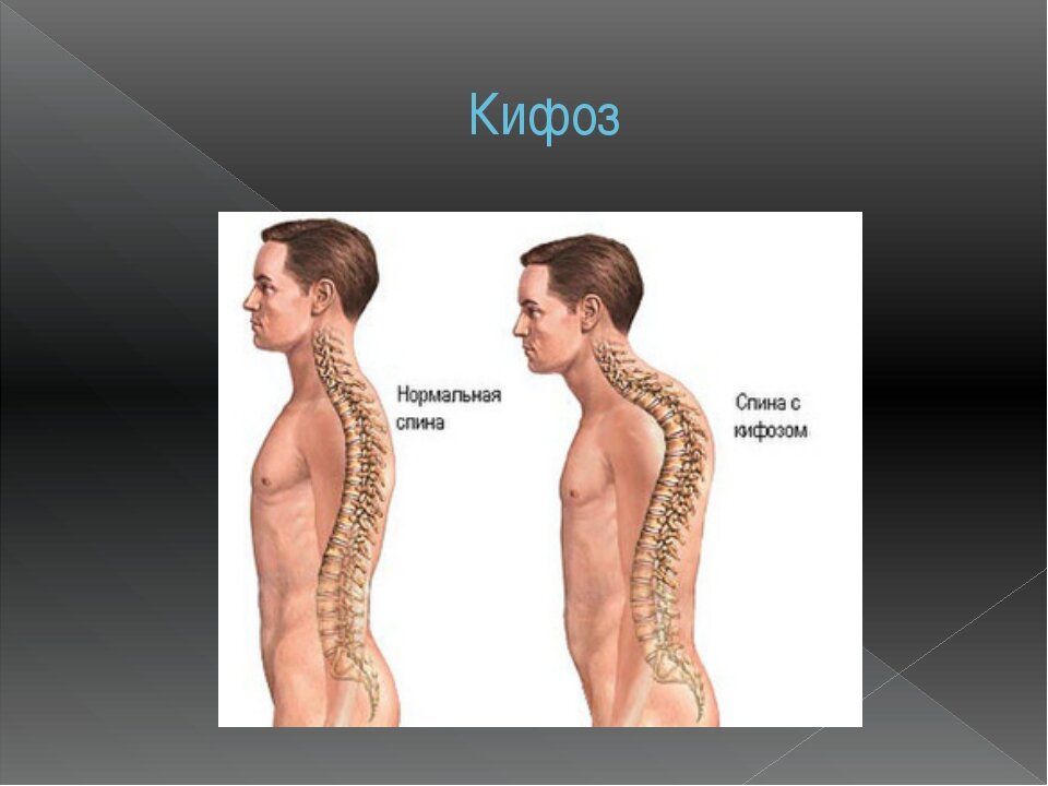 Кифоз что это. Искривление позвоночника болезнь Шейермана МАУ. Шармана МАУ болезнь позвоночника. Изгибы позвоночника лордоз и кифоз.