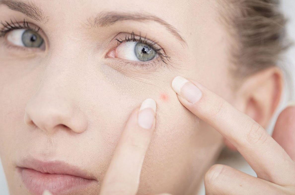 Акне: постоянная тема и проблема не только среди  подростков, но также эта проблема волнует взрослых женщин и мужчин. Почему нас это  беспокоит? Причин достаточно много , почему появляются прыщи, существует огромное количество тем, однако, гормональные изменения у женщин и у мужчин возникают при неправильном уходе  за кожей. В данной  статье мы расскажем вам о 5 способах, как с помощью природных компонентов можно избавиться от прыщей. В первую очередь избегайте химических компонентов и выберите путь естественный. Важно не потерять надежду, быть терпеливым и лечить прыщи не только поверхностно, но, прежде всего, изнутри.