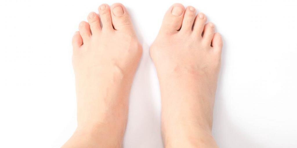 Шишки на больших пальцах ноги