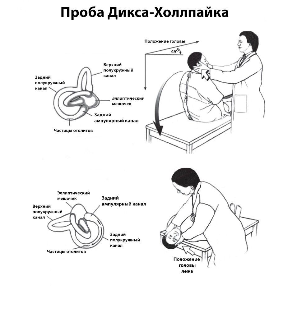 Позиционное головокружение симптомы. Проба Дикса-Холлпайка. ДППГ доброкачественное пароксизмальное позиционное. Доброкачественное пароксизмальное позиционное головокружение. ДППГ прием Дикса Холлпайка.