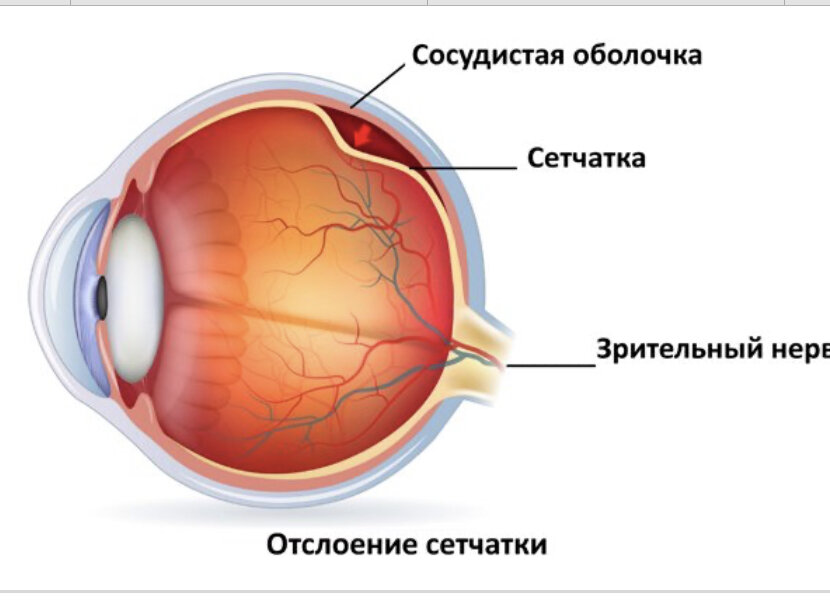 Отслойка сетчатки картинки