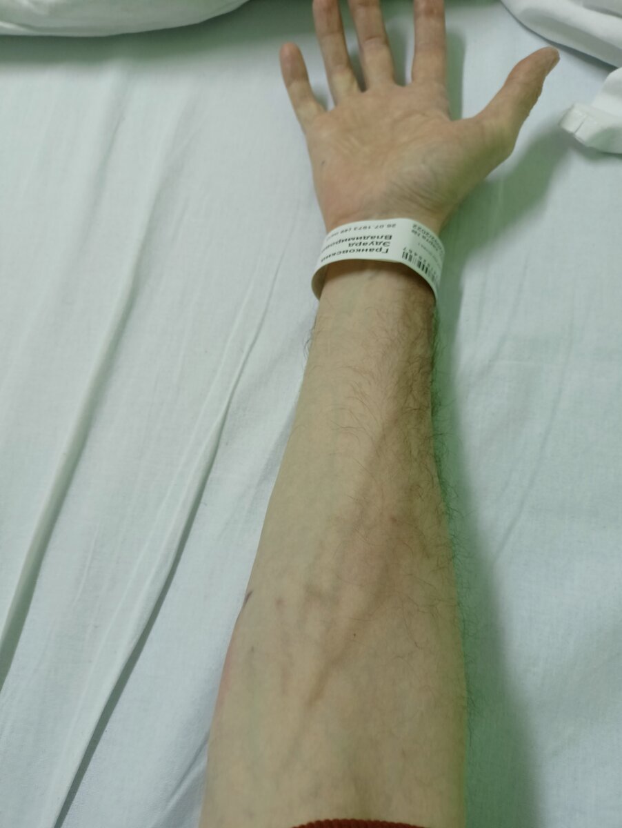 Это вены на моей правой руке (следы после второй химиотерапии)