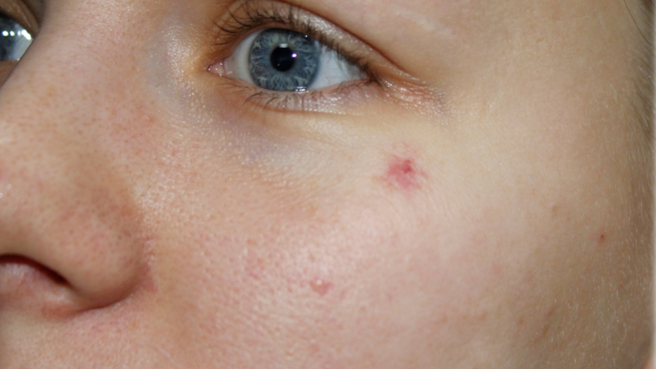 Паутинчатая ангиома ("сосудистая звездочка") на лице.