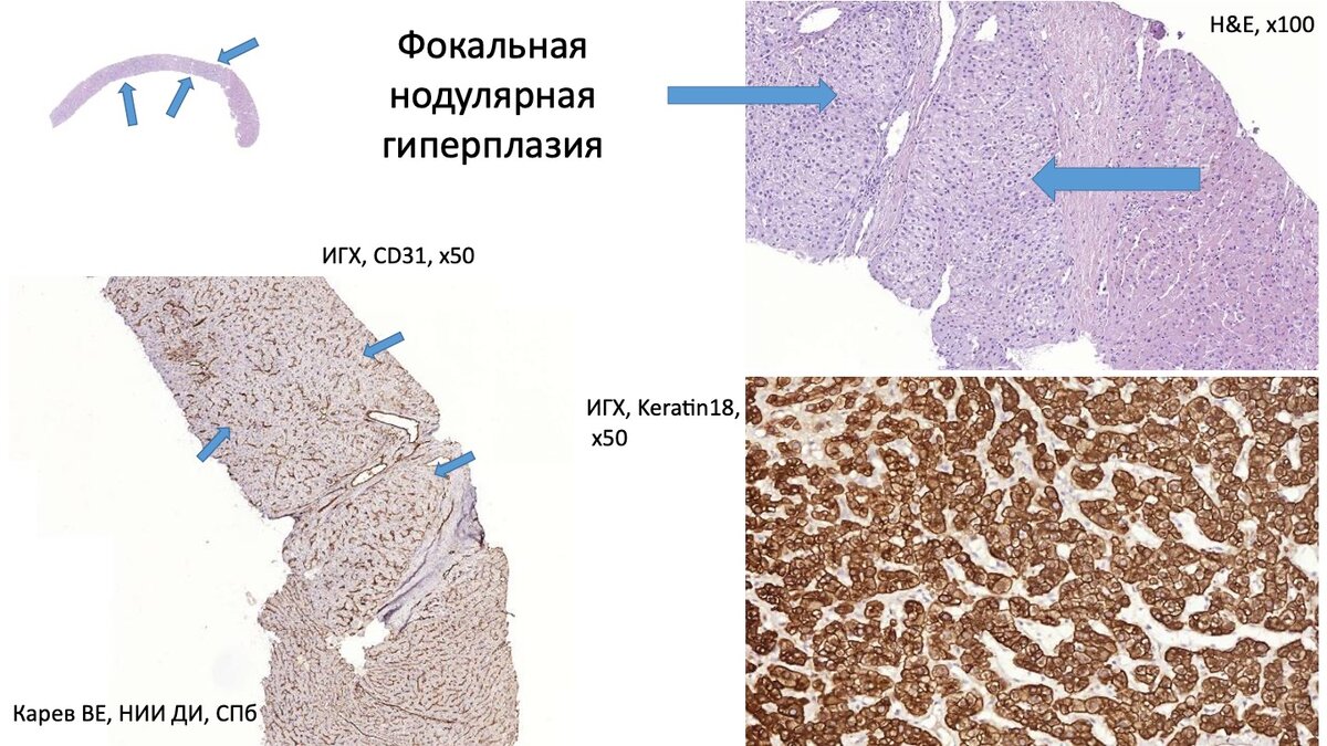 Фокальный некроз. Нодулярная гиперплазия. Фокальная нодулярная гиперплазия. Нодулярная гиперплазия надпочечников. Фокальная нодулярная гиперплазия печени.