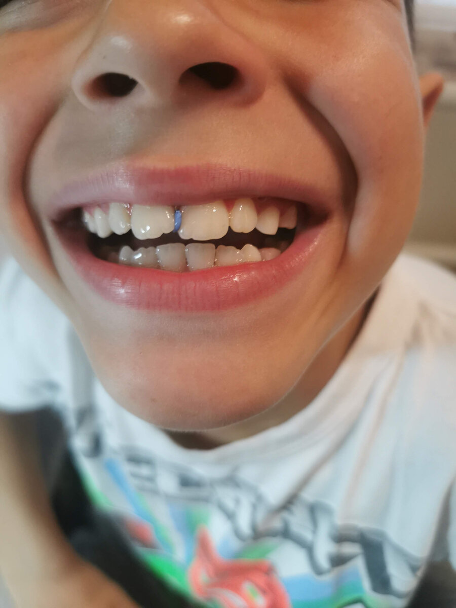 Синяя резиночка - раздвигает передние зубы, которые зачем-то пытаются обняться, хотя места для них достаточно. Природный цвет эмали очень красивый