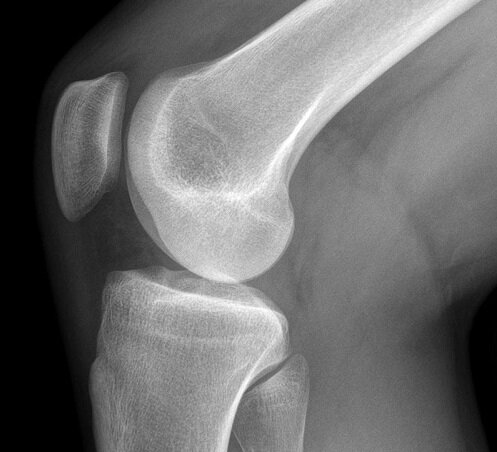 Рентгенограмма коленного сустава в боковой проекции