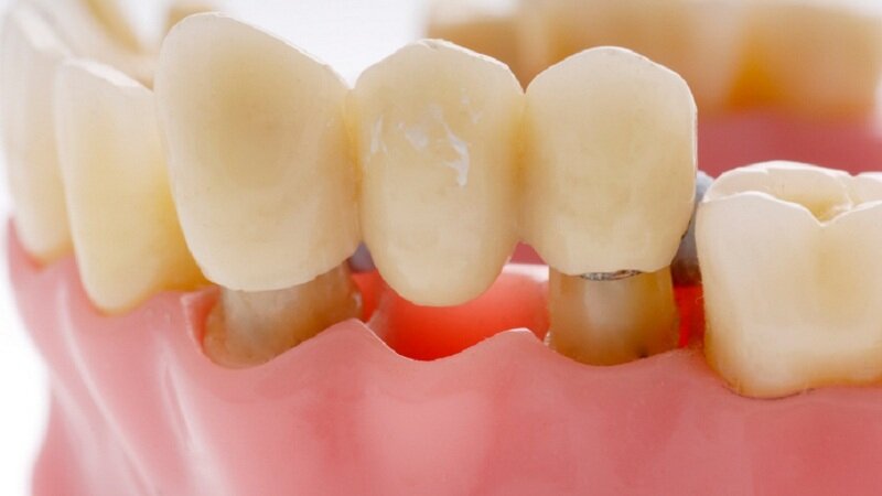 мостовидный зубной протез