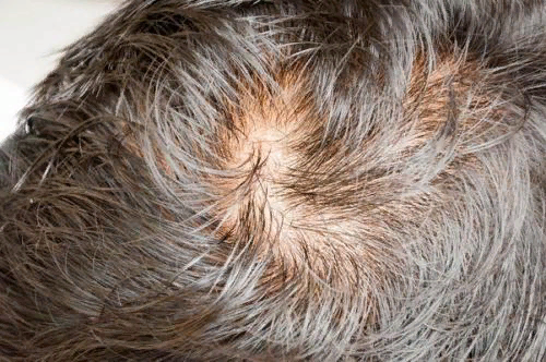 Частое мытье головы ускоряет выпадение волос?