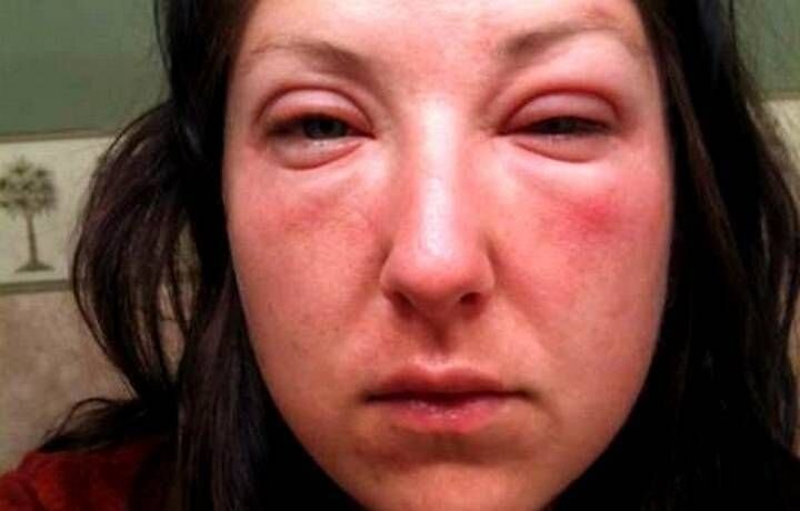 Кроме общей отечности тела, по утрам возникает отечность лица, что не красит женщину.