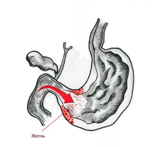 Рвота желчью: что делать, как остановить, причины, лечение