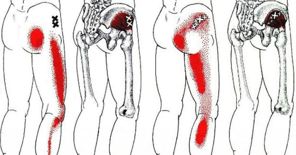 Триггерные точки на ягодицах фото