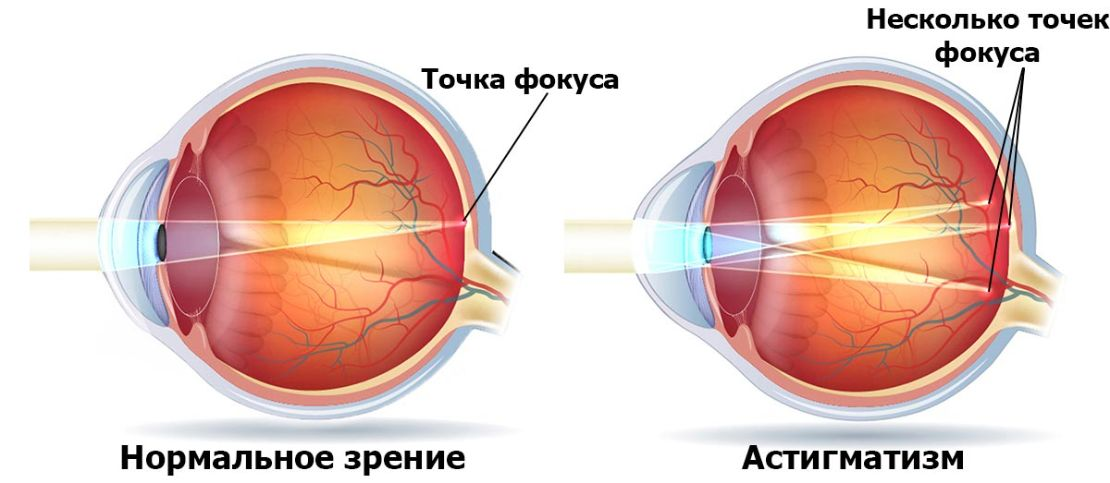 Лечится ли астигматизм у детей – причины и лечение детского астигматизма