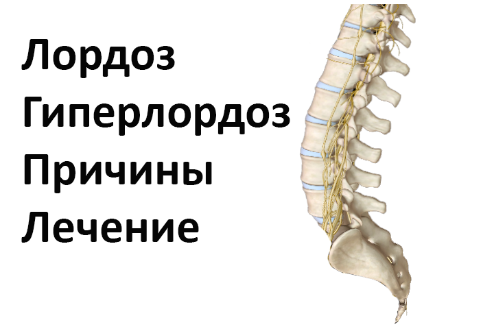 Гиперлордоз - чрезмерный прогиб позвоночника вперед.
