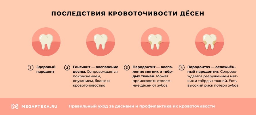 Привкус крови во рту причины. Привкус железа во рту причины. Почему металлический вкус во рту.