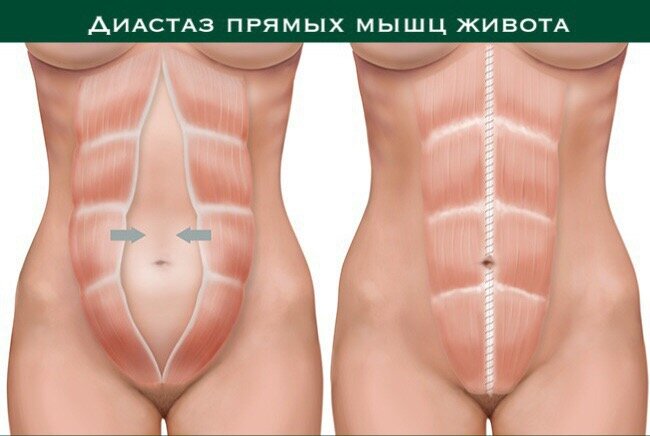Диастаз