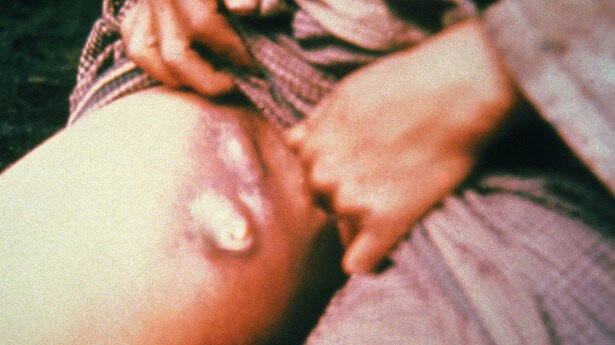 Опухшие лимфатические узлы