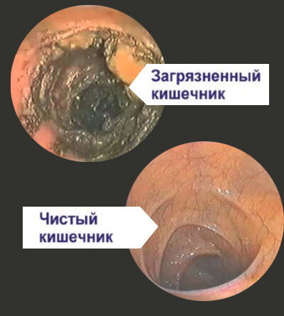 Загрязненный кишечник