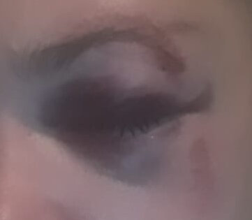 Мой глаз на утро после падения. Вам страшно? Мне - да!